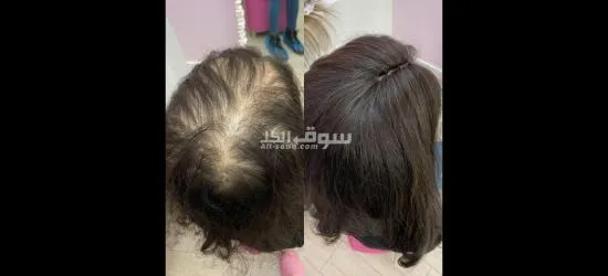 منتج للعناية بالشعر مكون من ٣ قطع - 6