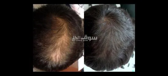 منتج للعناية بالشعر مكون من ٣ قطع - 7